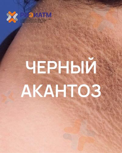 Вы заметили, что кожа на шее, подмышках или в паху потемнела, стала плотной и шершавой?