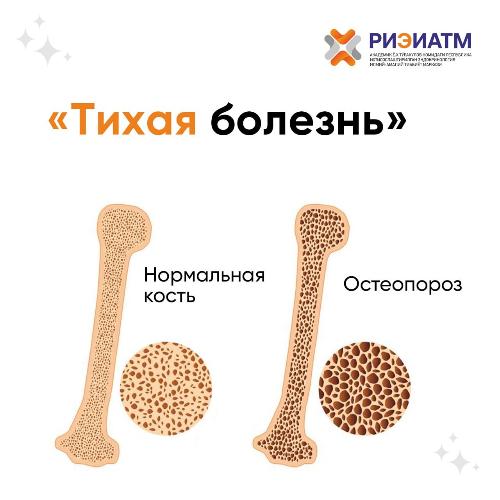 Osteoporosis is often called a “silent” disease, because the disease progresses slowly and has no symptoms for a long time, and a fracture (most often of the wrist, femoral neck, spine) can occur even due to a minor trauma.